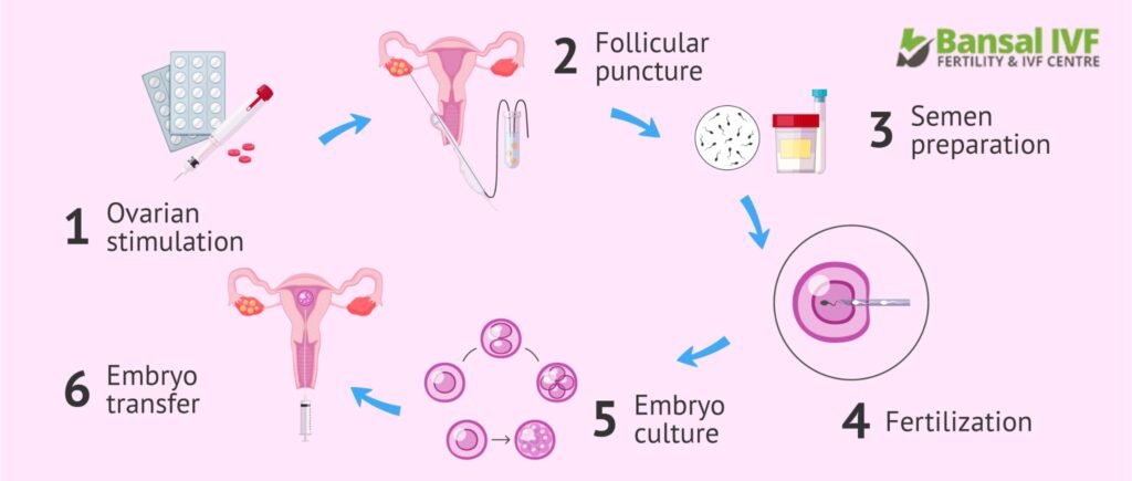 In-Vitro Fertilization