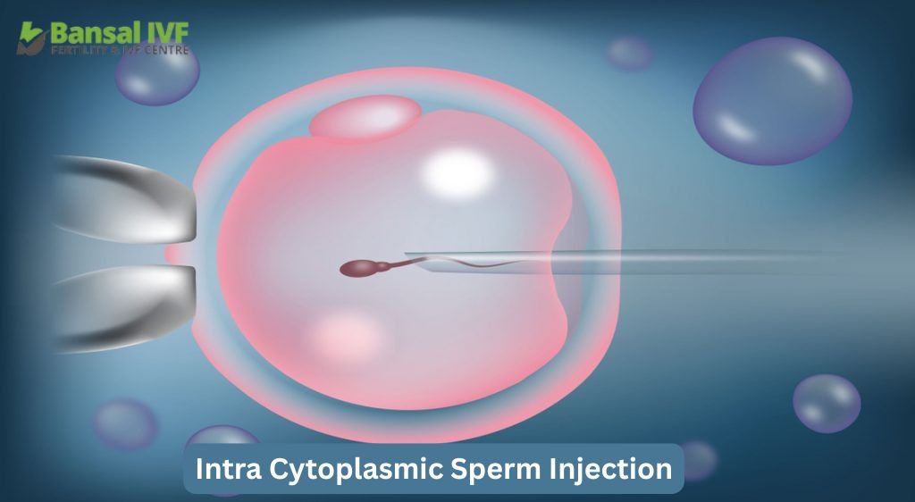 intra-cytoplasmic Sperm-injection