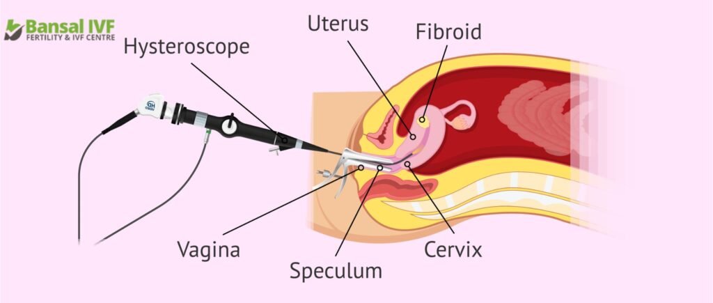 Process-Of-Hysteroscopy