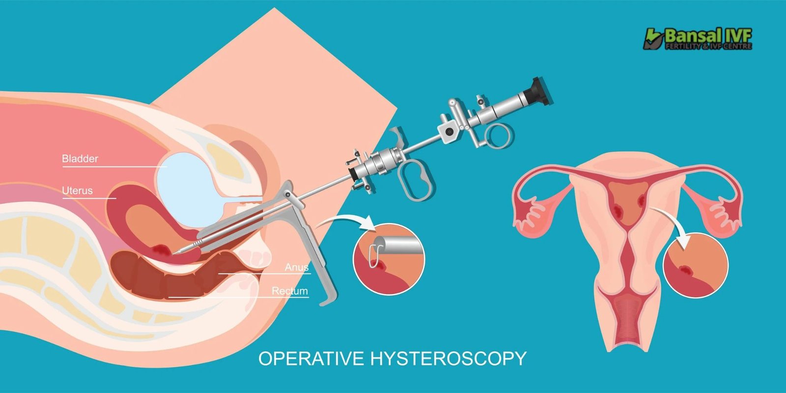 Hysteroscopy