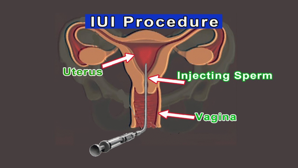 IUI-Centre-In-Sonipat