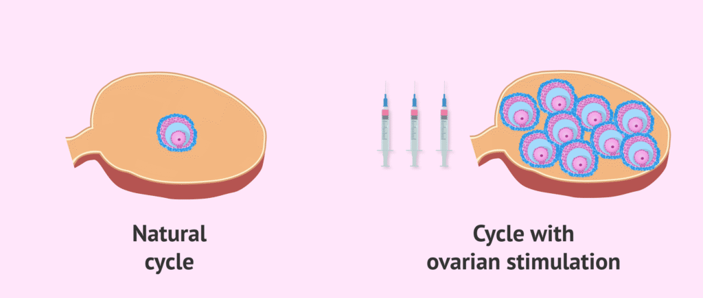 IUI-Procedure