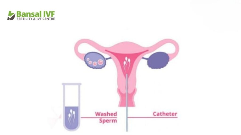 IUI-Treatment-for-Pregnancy