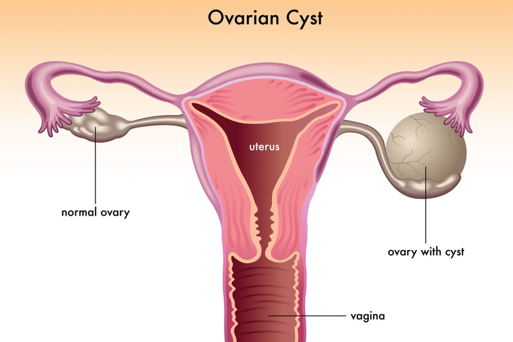 Ovarian-Cyst