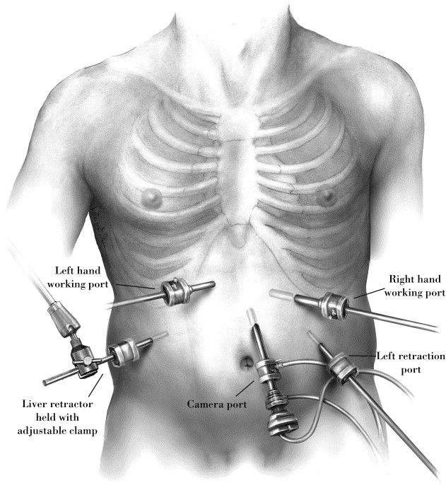 Diagnostic-Laparoscopy