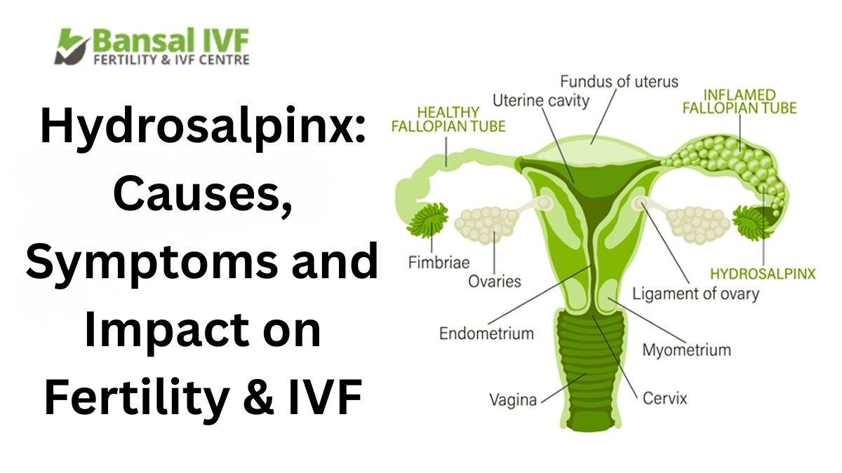 Hydrosalpinx