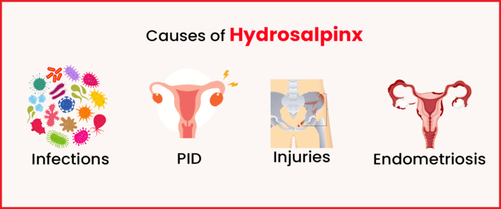 causes-of-hydrosalpinx