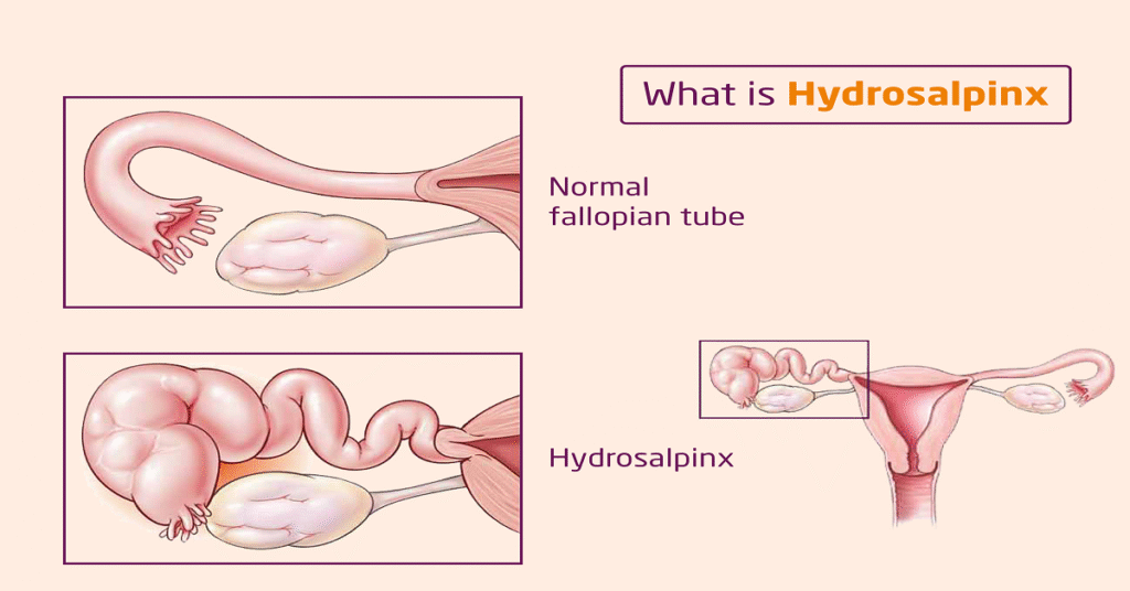 Hydrosalpinx-Role-In-Fertilisation