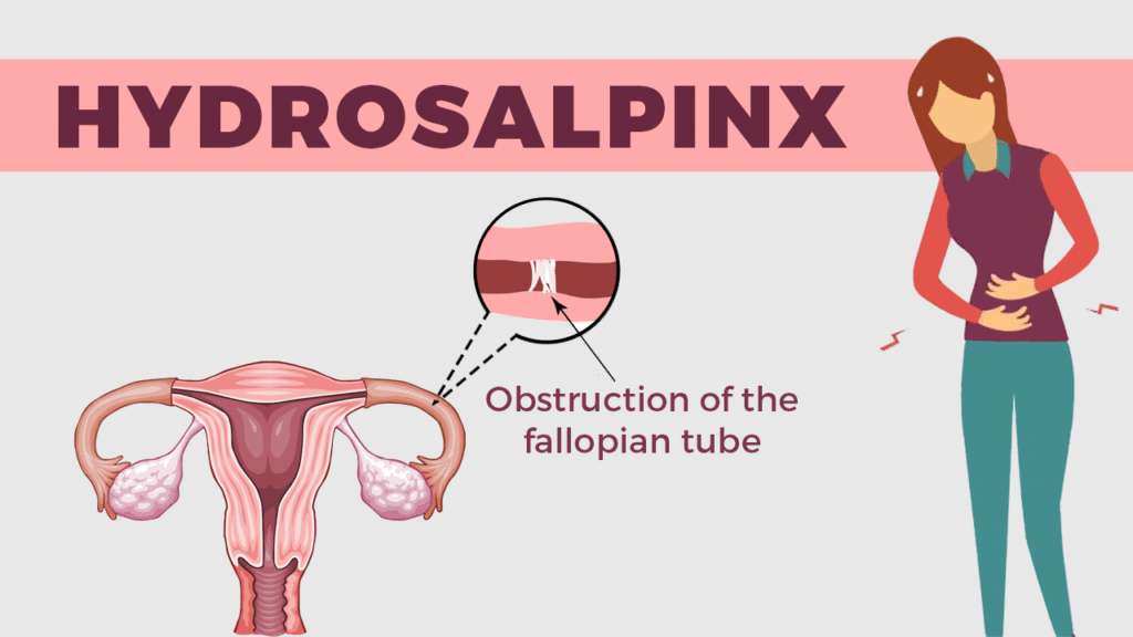 Hydrosalpinx-Role-In-Fertilisation