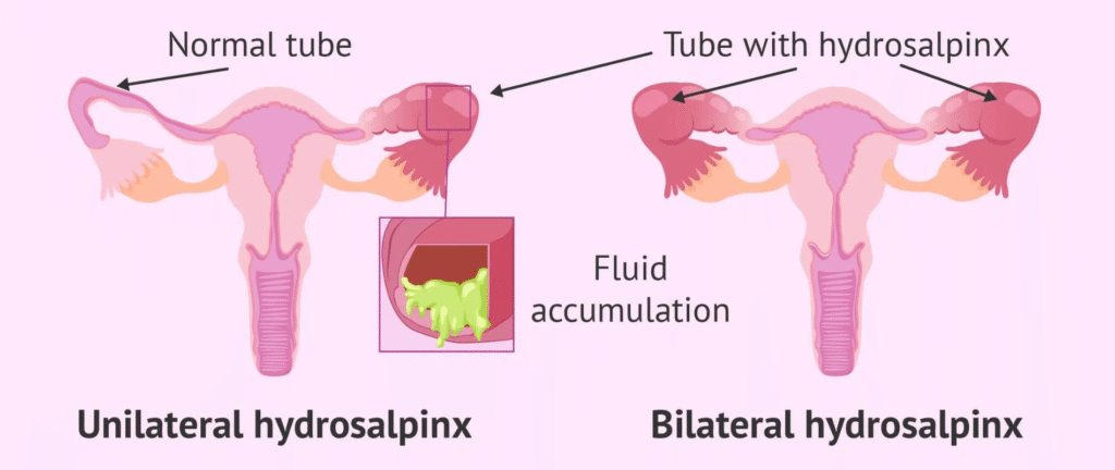 Hydrosalpinx-Role-In-Fertilisation