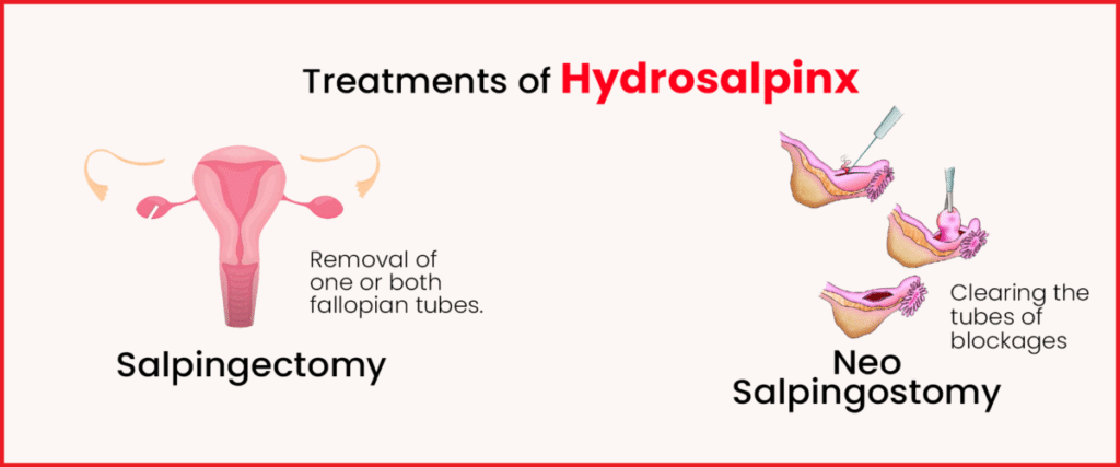 Hydrosalpinx-Role-In-Fertilisation