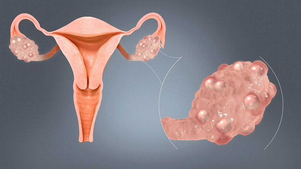 polycystic-ovarian-syndrome