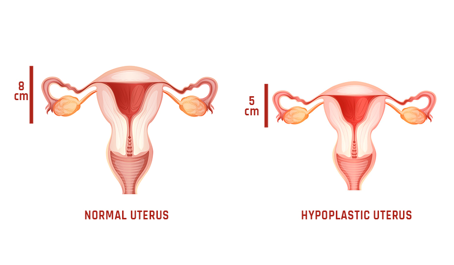 Small-Uterus-Symptoms