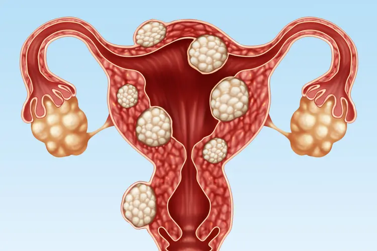Small-Uterus