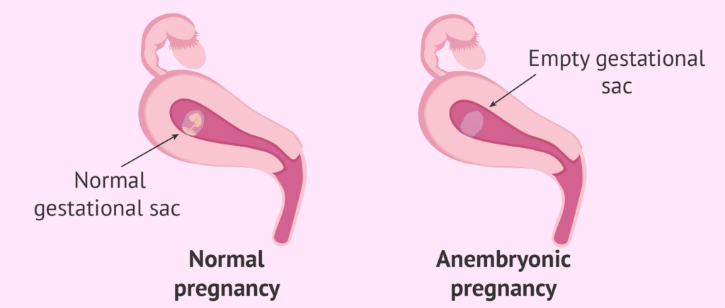 Biochemical-Pregnancy