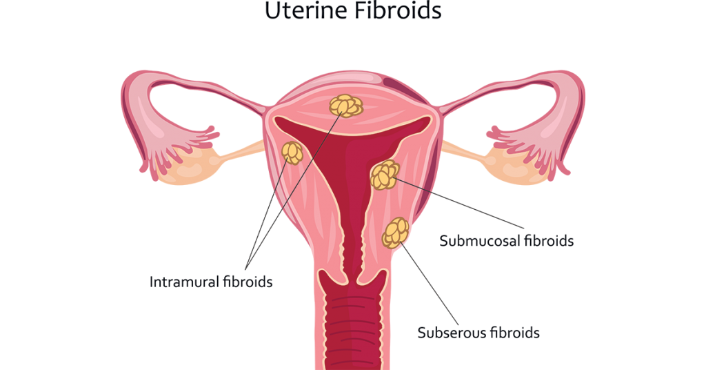 Fibroids-In-Uterus