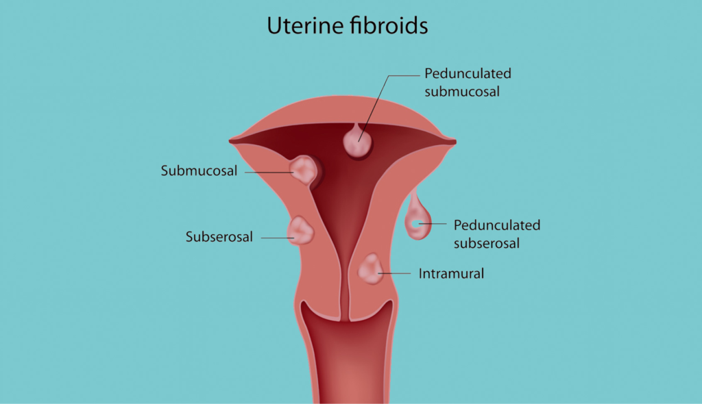 fibroids-in-uterus