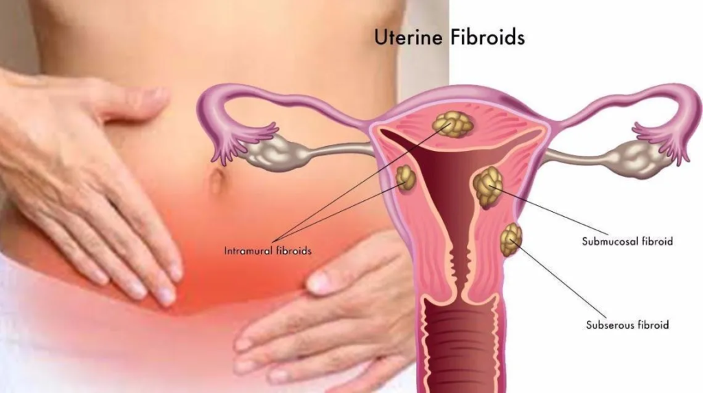 fibroids-in-uterus