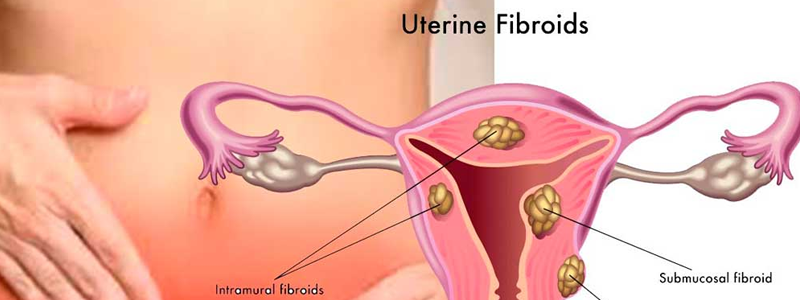 fibroids-in-uterus